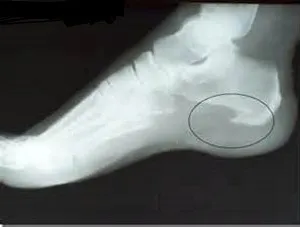 Exostosis cauze reale - simptome, tratament, prevenirea (motivele) Exostosis cauze reale - simptome, tratament, prevenire