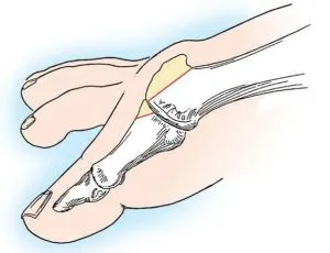 Exostosis cauze reale - simptome, tratament, prevenire (exostoze a calcaneului) Exostosis cauze reale - simptome, tratament, prevenire