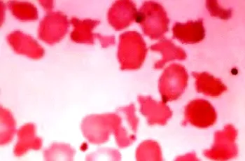 Modificarea dimensiunii roșu microcytosis celulelor sanguine, macrocitoza, megalotsitoz, shizotsitoz, anizocitoză