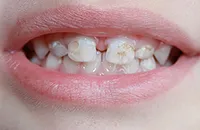 Cum sa scapi de cariilor dentare la domiciliu - tehnici de dovedit (cum să scape de cariilor dentare pe dinti) Cum sa scapi de cariilor dentare la domiciliu - metode dovedite
