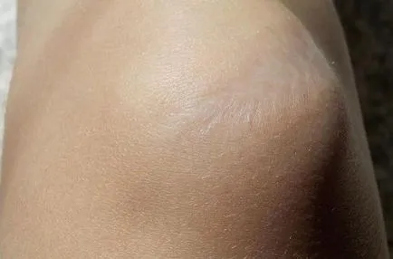 Cum sa scapi de cicatrici tehnici cosmetice si chirurgicale (cheloide hipertrofice) Cum să scapi de cicatrici cosmetice și tehnici chirurgicale