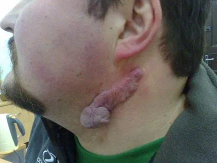 Cum să scapi de cicatrici cosmetice și metode chirurgicale (a scăpa de) Cum să scapi de cicatrici cosmetice și tehnici chirurgicale