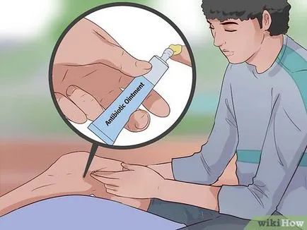 Cum de a trata o cheloid