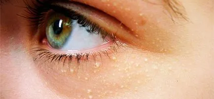 Cum de a elimina talc sub ochi pentru a scăpa și de a elimina Wen pe pleoape și în jurul ochilor (ochi) Cum de a elimina talc sub ochi pentru a scăpa și de a elimina Wen pe pleoape și în jurul ochilor