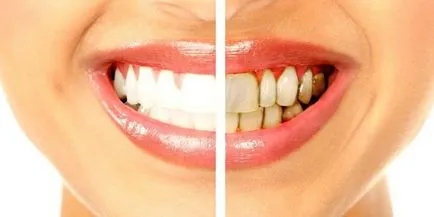 Cum de a elimina placa dentară la domiciliu - metode pentru indepartarea petelor de culoare închisă și galben (intern) Cum de a elimina placa dentară la domiciliu - metode pentru indepartarea petelor de culoare închisă și galben