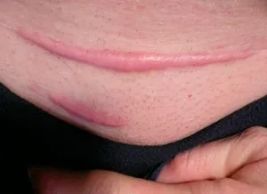 Keloids cauze etapă de tratament și
