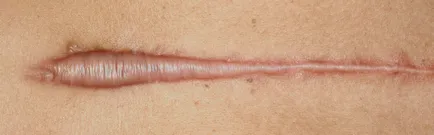 motive Keloids pentru formarea, tratarea și eliminarea cicatrici cheloide, metode