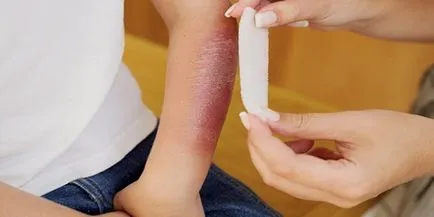 Cheloide cauze formarea de cicatrice, tratarea și îndepărtarea cicatricilor