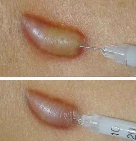 motive Keloids pentru formarea, tratarea și eliminarea cicatrici cheloide, metode