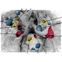 trunchiul pulmonar 1