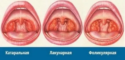 Tratamentul Sore în practicile de medicină de copii populare în casă, cum să trateze