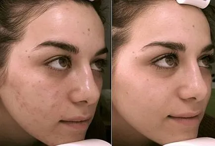 migdale peeling