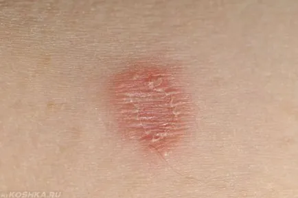 Poate o persoană care face pecingine dintr-o pisica daca zona zoster este contagioasă