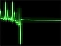 bloc incomplet de ramură pe picioare ECG (dreapta) blocadă incompletă pachet dreptul de ramură pe o electrocardiograma