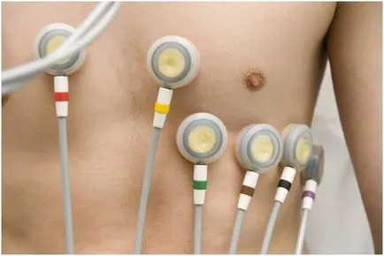 bloc incomplet de ramură pe picioare ECG (dreapta) blocadă incompletă pachet dreptul de ramură pe o electrocardiograma