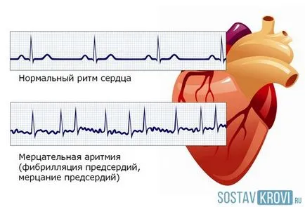 tulburare de ritm cardiac cauze, tipuri, simptome, diagnostic și tratament de aritmie (inima) tulburare de ritm cardiac cauze, tipuri, simptome, diagnostic si tratament de aritmie