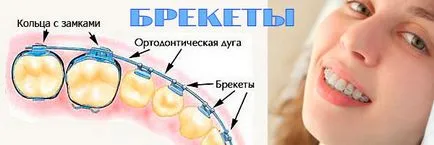 Ortodonție in stomatologie - de ce a pus aparat dentar, de ce musca fix, de ce a pus aparat dentar