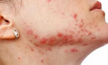Sindrilele simptome și tratament pentru adulți (tipuri de herpes) Simptome herpes zoster și tratament la adulți