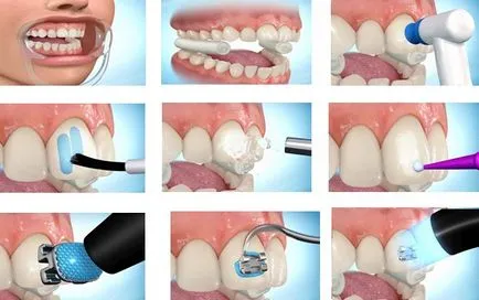 Ortodonție in stomatologie - de ce a pus aparat dentar, de ce musca fix, de ce a pus aparat dentar