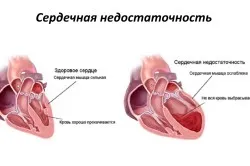 Primul ajutor pentru insuficienta cardiaca acuta