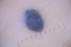 Pigmentata nev ce este, fotografie, tipuri, cauze, simptome, diagnostic, tratament (Becker nev foto) Pigmentata nev ce este, fotografie, tipuri, cauze, simptome, diagnostic, tratament