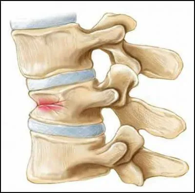 fracturi osoase și clasificarea (care sunt), complicații (fracturi) fracturi osoase și clasificarea (care sunt), complicații