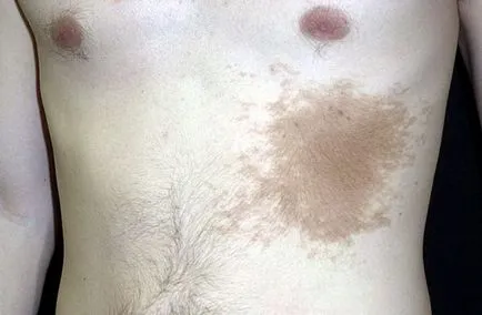 Pigmentata nev ce este, fotografie, tipuri, cauze, simptome, diagnostic, tratament (nev melanocitar congenital) Pigmentata nev ce este, fotografie, tipuri, cauze, simptome, diagnostic, tratament