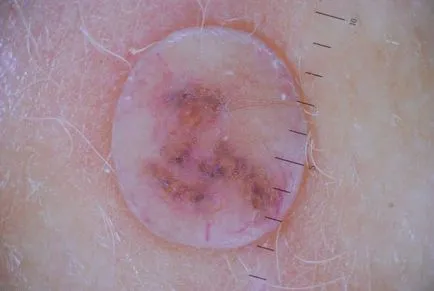 Pigmentata nev ce este, fotografie, tipuri, cauze, simptome, diagnostic, tratament (tipuri de nevi foto) Pigmentata nev ce este, fotografie, tipuri, cauze, simptome, diagnostic, tratament
