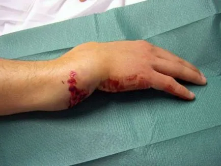 fracturi osoase și clasificarea (care sunt), complicații (osoase) fracturi osoase și clasificarea (care sunt), complicații