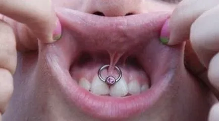 Piercing Smiley - fotografii, durere, consecinte, riscuri, pret