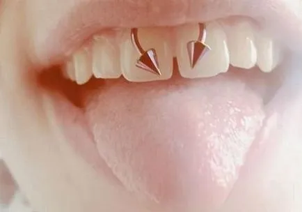 Piercing Smiley - fotografii, durere, consecinte, riscuri, pret