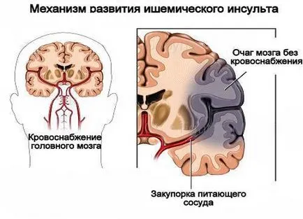 Consecințele infarctului cerebral