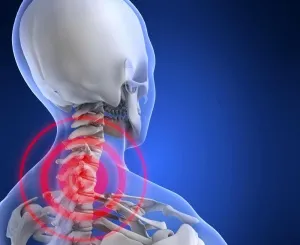Proeminența coloanei cervicale, tratamentul proeminenței discului de col uterin