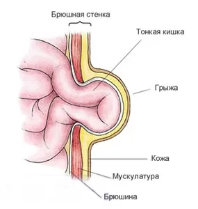 hernie ombilicala la copii, prevenirea, diagnosticarea și tratamentul acestei boli