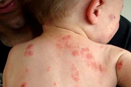 Psoriazisul la copii cauze, simptome și tratament - un ghid pentru boli de piele (copii) Psoriazisul la copii cauze, simptome și tratament - un ghid pentru boli de piele