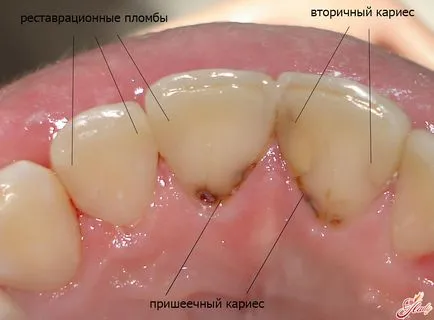Este posibil pentru a scăpa de cariilor dentare la domiciliu fără medici (casă) Este posibil pentru a scăpa de cariilor dentare la domiciliu, fara medici
