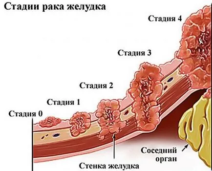 Diagnosticul Explicarea cancerului, stadiul de cancer, evaluarea calității asistenței medicale cu cancer