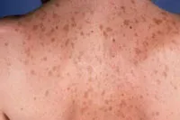Alunițele un triunghi - valoarea trei, în formă, forma, pe braț, gât, față, abdomen (moli) Alunițele un triunghi - valoarea trei, în formă, forma, pe braț, gât, față, abdomen