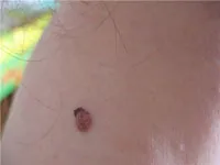 Alunițele un triunghi - valoarea trei, în formă, forma, pe braț, gât, față, abdomen (valoare) Alunițele un triunghi - valoarea trei, în formă, forma, pe braț, gât, față, abdomen