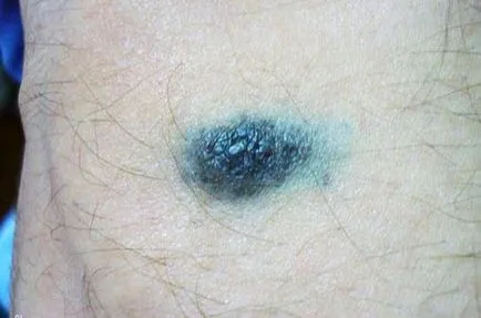 Alunițele un triunghi - valoarea trei, în formă, forma, pe braț, gât, față, abdomen (forma) Alunițele un triunghi - valoarea trei, în formă, forma, pe braț, gât, față, abdomen