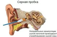Cerumen în ureche - cum să eliminați la domiciliu, cum să scape