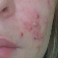 Perlele sub piele de pe fața cauzelor, tratamente, sfaturi (fata) Perlele sub piele de pe fața cauzelor, tratamente, sfaturi