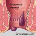 Fonduri de la hemoroizi