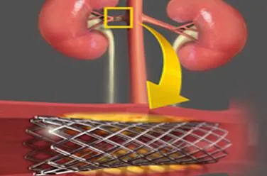 Stenting - ceea ce este costa stenting nave ale inimii