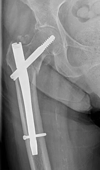 Îndepărtarea structurilor metalice după osteosinteză, îndepărtarea spițele plăcilor după fractură