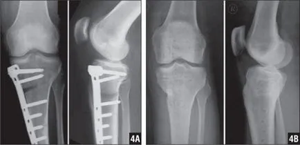 Îndepărtarea structurilor metalice după osteosinteză, îndepărtarea spițele plăcilor după fractură