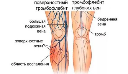 Un cheag de sânge în picior cauze, simptome, tratament și consecințe (simptome) Un cheag de sânge în picior cauze, simptome, tratament și consecințe