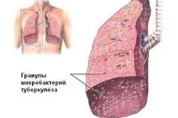 Uzi pulmonar cavitatea pleurală