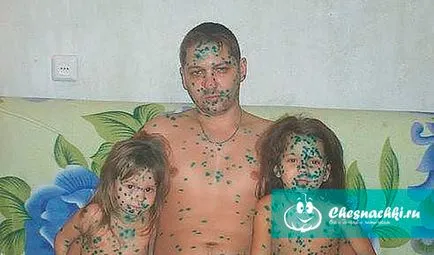 Varicela incubare perioada contagiozitate și tratată (incubare) Perioada de incubare Varicela și infectivitatea decât vindecarea