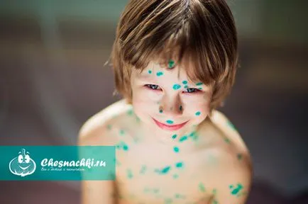 Varicela incubare perioada contagiozitate și tratată (incubare perioada contagiozitate) Perioada de incubare Varicela și infectivitatea decât vindecarea